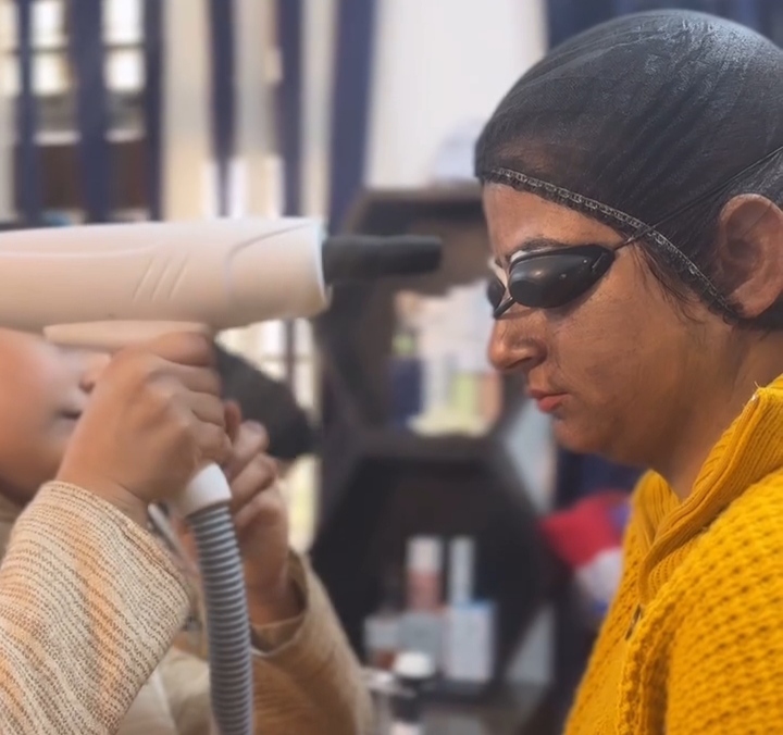 Carbon Laser Facial System