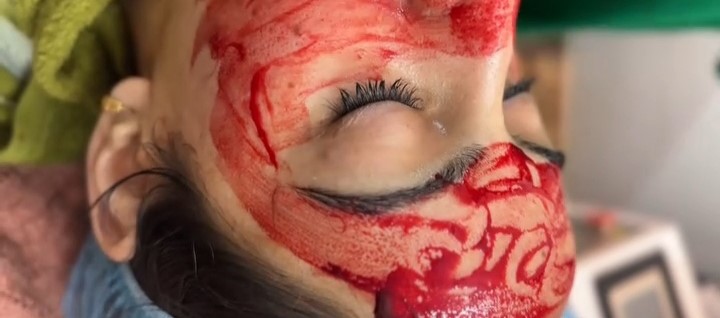 Vampire Facial